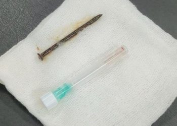 Pria di Inhil Tersedak Paku 5 Cm hingga Paru-paru saat Perbaiki Kamar Anak