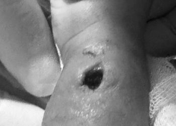 Tangan Bayi Berlubang Diduga Korban Malpraktik, RS di Makassar Buka Suara